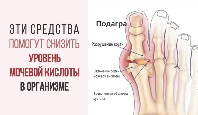 Вот как избавиться от мочевой кислоты и вылечить подагру!
