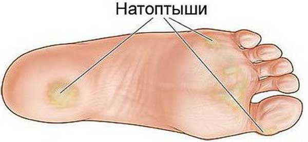 Простые рецепты для устранения натоптышей, трещин, мозолей, сосудистой сетки и варикоза!