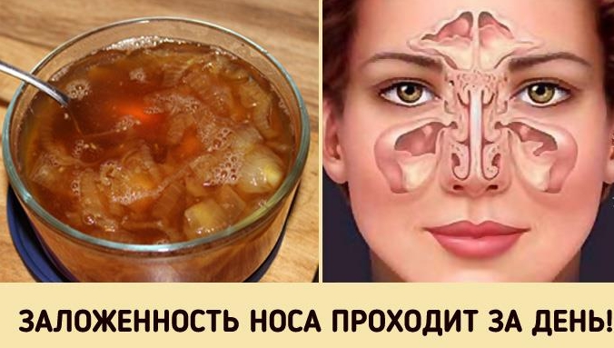 Супер-средство от заложенного носа. Будете свободно дышать уже на утро!