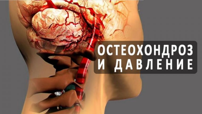 Шейный остеохондроз и высокое давление как неразлучная парочка