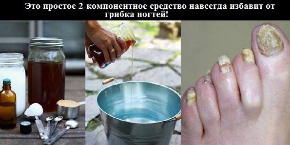 Это простое 2-компонентное средство навсегда избавит от грибка ногтей!